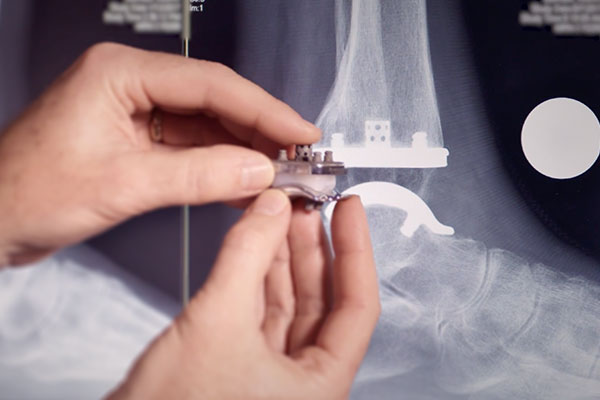 Exactech Ankle Replacement
