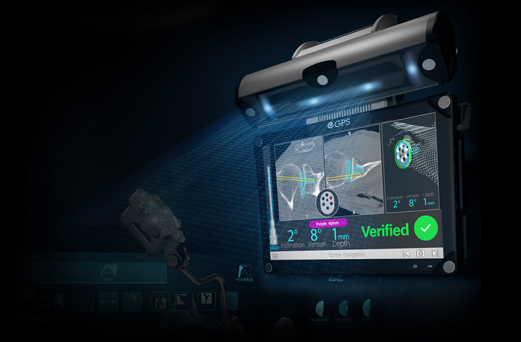 Exactech Shoulder GPS System