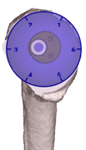 Exactech Shoulder Equinoxe Planning App - Adjust humeral head offset / position in anatomic procedures