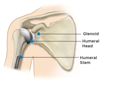 Anatomic Shoulder Replacement