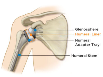 Reverse Shoulder Replacement